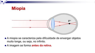 Miopia
◼ A miopia se caracteriza pela dificuldade de enxergar objetos
muito longe, ou seja, no infinito.
◼ A imagem se forma antes da retina.
 
