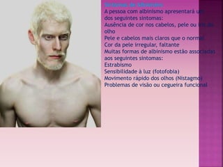 Sintomas de Albinismo 
A pessoa com albinismo apresentará um 
dos seguintes sintomas: 
Ausência de cor nos cabelos, pele ou íris do 
olho 
Pele e cabelos mais claros que o normal 
Cor da pele irregular, faltante 
Muitas formas de albinismo estão associadas 
aos seguintes sintomas: 
Estrabismo 
Sensibilidade à luz (fotofobia) 
Movimento rápido dos olhos (Nistagmo) 
Problemas de visão ou cegueira funcional 
 