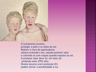 O tratamento envolve 
proteger a pele e os olhos do sol: 
Reduzir o risco de queimaduras 
solares evitando o sol, usando protetor solar 
e cobrindo se com roupas quando exposto ao sol. 
O protetor solar deve ter um fator de 
proteção solar (FPS) alto. 
Óculos escuros (com proteção UV) 
podem aliviar a sensibilidade à luz 
 