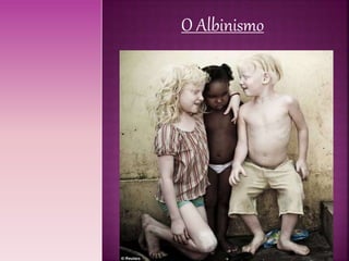 PPT - Albinismo O branco que a natureza merece. PowerPoint Presentation -  ID:5252138