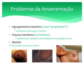 Ingurgitamento mamário: (Leite “empedrado”):
* Tratamento: massagem e ordenha
Fissuras mamilares :(rachaduras)
Tratamento: o próprio Leite Materno e exposição ao sol.
Mastite:
* Tratamento:Compressas mornas
Problemas da Amamentação
 
