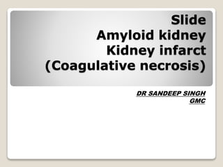 Slide
Amyloid kidney
Kidney infarct
(Coagulative necrosis)
DR SANDEEP SINGH
GMC
 