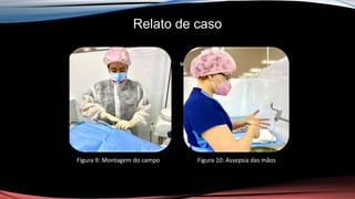 Relato de caso
ur
Figura 9: Montagem do campo Figura 10: Assepsia das mãos
 