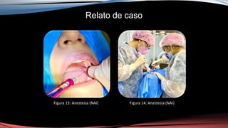 Relato de caso
Figura 13: Anestesia (NAI) Figura 14: Anestesia (NAI)
 