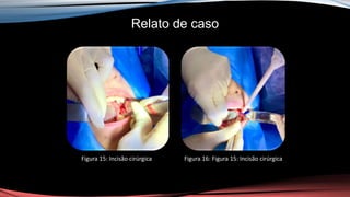 Relato de caso
Figura 15: Incisão cirúrgica Figura 16: Figura 15: Incisão cirúrgica
 