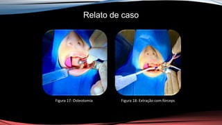 Relato de caso
Figura 17: Osteotomia Figura 18: Extração com fórceps
 