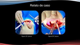 Relato de caso
Figura 19: Sutura Figura 20: Sutura
 
