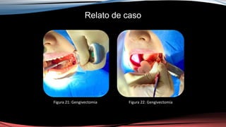 Relato de caso
Figura 21: Gengivectomia Figura 22: Gengivectomia
 