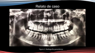 Relato de caso
Figura 1: Radiografia panorâmica
 