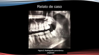 Relato de caso
Figura 2: Radiografia panorâmica
ampliada
 