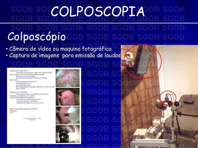 Exame colposcopia video