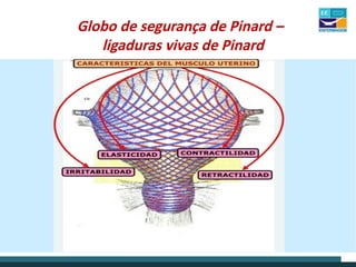 Globo de segurança de Pinard –
ligaduras vivas de Pinard
 
