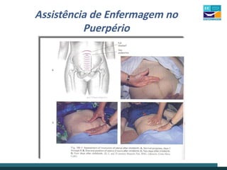 Assistência de Enfermagem no
Puerpério
 