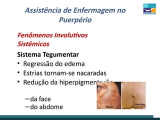 Assistência de Enfermagem no
Puerpério
Fenômenos Involutivos
Sistêmicos
Sistema Tegumentar
• Regressão do edema
• Estrias tornam-se nacaradas
• Redução da hiperpigmentação
–da face
–do abdome
 