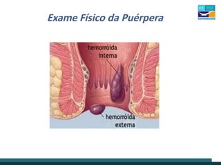 Exame Físico da Puérpera
 