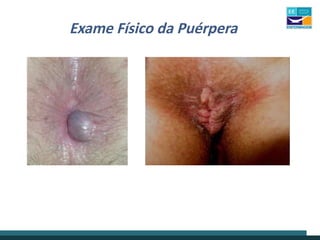 Exame Físico da Puérpera
 