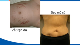 Vết rạn da
Sẹo mổ cũ
 
