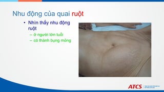 Nhu động của quai ruột
• Nhìn thấy nhu động
ruột
– ở người lớn tuổi
– có thành bụng mỏng
 
