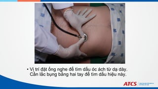 • Vị trí đặt ống nghe để tìm dấu óc ách từ dạ dày.
Cần lắc bụng bằng hai tay để tìm dấu hiệu này.
 