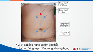 Động mạch
chủ bụng
Động mạch
thận
Động mạch
chậu ngoài
Động mạch
đùi
• Vị trí đặt ống nghe để tìm âm thổi
của các động mạch lớn trong khoang bụng
 