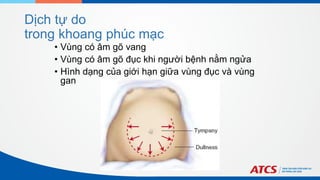 Dịch tự do
trong khoang phúc mạc
• Vùng có âm gõ vang
• Vùng có âm gõ đục khi người bệnh nằm ngửa
• Hình dạng của giới hạn giữa vùng đục và vùng
gan
 