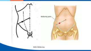 Điểm McBurney
 