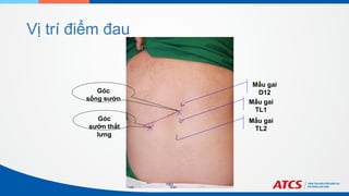 Vị trí điểm đau
Mấu gai
D12
Mấu gai
TL1
Mấu gai
TL2
Góc
sườn thắt
lưng
Góc
sống sườn
 