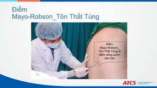 Điểm
Mayo-Robson_Tôn Thất Tùng
Điểm
Mayo-Robson_
Tôn Thất Tùng là
điểm sống sườn
bên trái
 