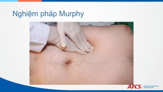 Nghiệm pháp Murphy
 