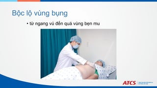 Bộc lộ vùng bụng
• từ ngang vú đến quá vùng bẹn mu
 