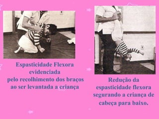 Espasticidade Flexora
         evidenciada
pelo recolhimento dos braços        Redução da
 ao ser levantada a criança     espasticidade flexora
                               segurando a criança de
                                 cabeça para baixo.
 