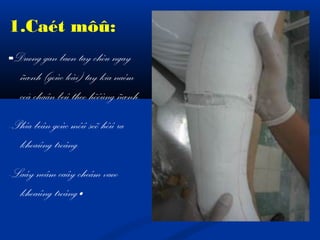 1.Caét môû:
-Duøng gan baøn tay chòu ngay

ñænh (goùc loài) tay kia naém
coå chaân beû theo höôùng ñænh.
-Phía beân goùc môû seõ hôû ra
khoaûng troáng.
-Laáy neâm caây cheâm vaøo
khoaûng troáng.

 