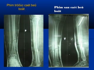 Phim tröôùc caét beû
boät

Phim sau caét beû
boät

 