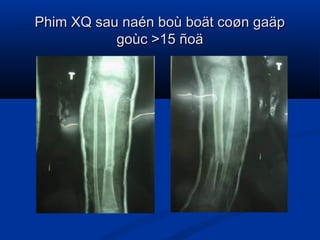 Phim XQ sau naén boù boät coøn gaäp
goùc >15 ñoä

 