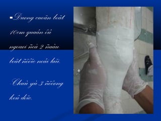 -Duøng cuoän boät

10cm quaán ôû
ngoaøi ñeå 2 ñaàu
boät ñöôïc noái laïi.
-Chuù yù 3 ñöôøng
keû doïc.

 