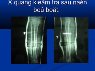 X quang kieåm tra sau naén
beû boät.

 