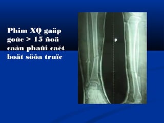 Phim XQ gaäp
goùc > 15 ñoä
caàn phaûi caét
boät söõa truïc

 