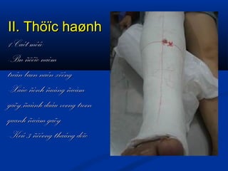 II. Thöïc haønh
1.Caét môû:
-Bn ñöôïc naèm
treân baøn naén xöông
-Xaùc ñònh ñuùng ñieåm
gaõy,ñaùnh daáu voøng troøn
quanh ñieåm gaõy
-Keû 3 ñöôøng thaúng doïc

 