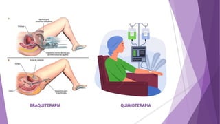BRAQUITERAPIA QUIMIOTERAPIA
 