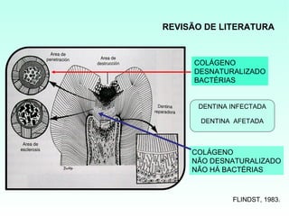 REVISÃO DE LITERATURA



     COLÁGENO
     DESNATURALIZADO
     BACTÉRIAS


      DENTINA INFECTADA

       DENTINA AFETADA



     COLÁGENO
     NÃO DESNATURALIZADO
     NÃO HÁ BACTÉRIAS



              FLINDST, 1983.
 