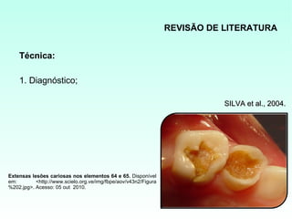REVISÃO DE LITERATURA


    Técnica:

    1. Diagnóstico;

                                                                            SILVA et al., 2004.




Extensas lesões cariosas nos elementos 64 e 65. Disponível
em:        <http://www.scielo.org.ve/img/fbpe/aov/v43n2/Figura
%202.jpg>. Acesso: 05 out 2010.
 