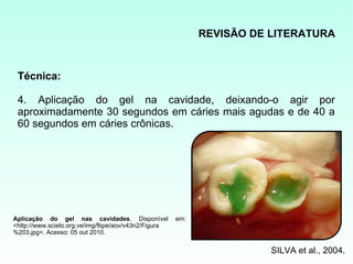 REVISÃO DE LITERATURA


 Técnica:

 4. Aplicação do gel na cavidade, deixando-o agir por
 aproximadamente 30 segundos em cáries mais agudas e de 40 a
 60 segundos em cáries crônicas.




Aplicação do gel nas cavidades. Disponível            em:
<http://www.scielo.org.ve/img/fbpe/aov/v43n2/Figura
%203.jpg>. Acesso: 05 out 2010.


                                                                       SILVA et al., 2004.
 