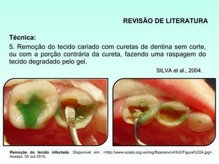 REVISÃO DE LITERATURA

Técnica:
5. Remoção do tecido cariado com curetas de dentina sem corte,
ou com a porção contrária da cureta, fazendo uma raspagem do
tecido degradado pelo gel.
                                                                           SILVA et al., 2004.




Remoção do tecido infectado. Disponível em: <http://www.scielo.org.ve/img/fbpe/aov/v43n2/Figura%204.jpg>.
Acesso: 05 out 2010.
 