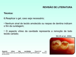 REVISÃO DE LITERATURA

  Técnica:

  6.Reaplicar o gel, caso seja necessário;

  • Nenhum sinal de tecido amolecido ou raspas de dentina indicam
  o fim da curetagem;

  • O aspecto vítreo da cavidade representa a remoção de todo
  tecido cariado;
                                                                         SILVA et al., 2004.




Aspecto       vítreo       das       cavidades.     Disponível    em:
<http://www.scielo.org.ve/img/fbpe/aov/v43n2/Figura%206.jpg>.  Acesso:
05 out 2010.
 