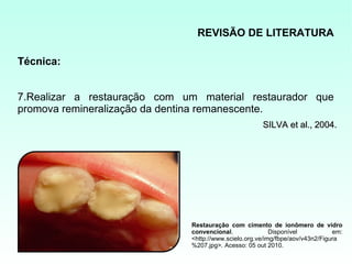 REVISÃO DE LITERATURA

Técnica:


7.Realizar a restauração com um material restaurador que
promova remineralização da dentina remanescente.
                                                      SILVA et al., 2004.




                              Restauração com cimento de ionômero de vidro
                              convencional.               Disponível           em:
                              <http://www.scielo.org.ve/img/fbpe/aov/v43n2/Figura
                              %207.jpg>. Acesso: 05 out 2010.
 