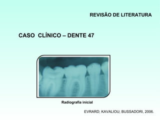 REVISÃO DE LITERATURA



CASO CLÍNICO – DENTE 47




             Radiografia inicial

                          EVRARD; KAVALIOU; BUSSADORI, 2006.
 