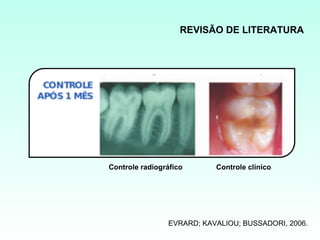 REVISÃO DE LITERATURA




Controle radiográfico      Controle clínico




                EVRARD; KAVALIOU; BUSSADORI, 2006.
 
