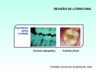 REVISÃO DE LITERATURA




Controle radiográfico    Controle clínico




                EVRARD; KAVALIOU; BUSSADORI, 2006.
 