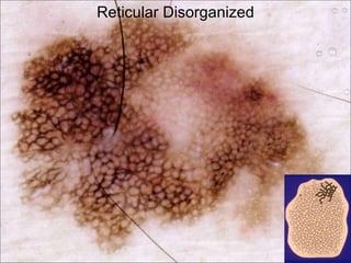 Reticular Disorganized
 