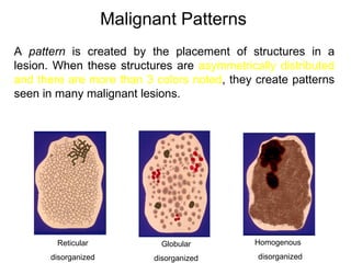 Malignant Patterns
A pattern is created by the placement of structures in a
lesion. When these structures are asymmetrically distributed
and there are more than 3 colors noted, they create patterns
seen in many malignant lesions.




        Reticular            Globular        Homogenous
      disorganized         disorganized      disorganized
 